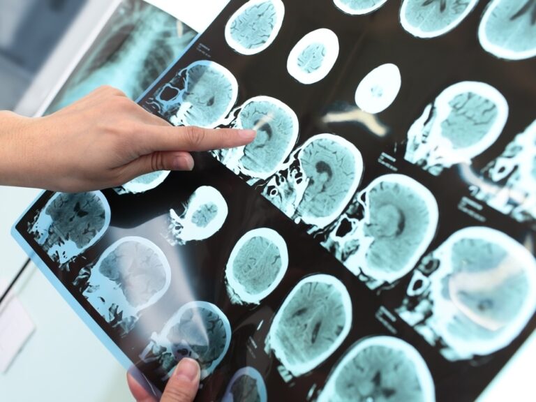 ViTA, il programma che aiuta i malati di Alzheimer a ricordare